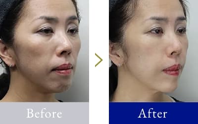 顔全体 40代半ば 女性