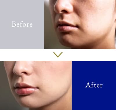 ほうれい線 30代 女性