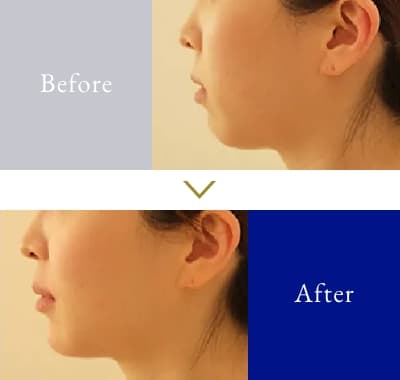 顎【あご】 30代前半 女性