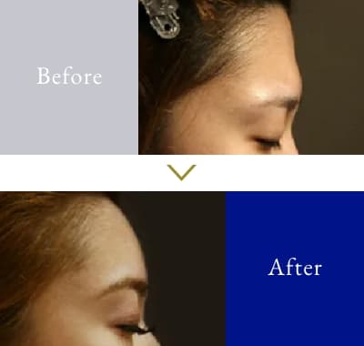 額【おでこ】 20代 女性